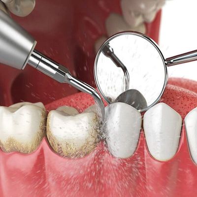 Zilveren Tand Ultra Multifunctioneel Sonic Scaler Tips Stainless Steel